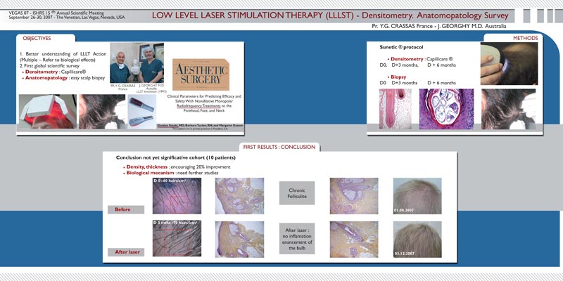 Dr. Crassas's LLLT and Inflammation Scalp Biopsy Findings